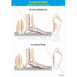 3367 Płaskostopie - układ kości i odcisk stopy