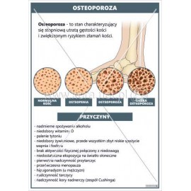 3629 Osteoporoza